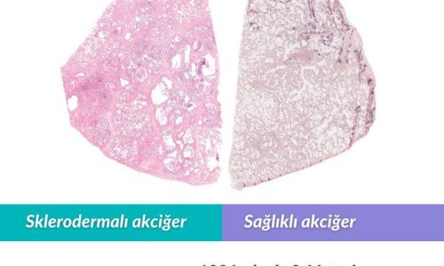 SSc'nin Tarihçesi -9- Matsui, Skleroderma'nın Sistemik Tutulumunu Bilimsel Olarak Kanıtladı - 2025.02.15